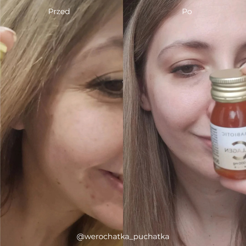 Efekty stosowania kolagenu - po suplementacji Primabiotic Collagen kondycja cery poprawiła się, zniknęły zmiany skórne