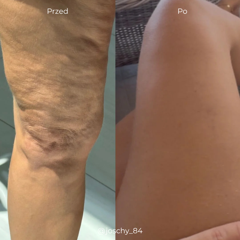 Efekty suplementacji kolagenu do picia - zmniejszony cellulit na udach