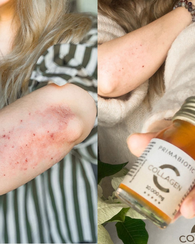 kobieta prezentująca efekty suplementacji kolagenu do picia Primabiotic Collagen - kolagen wspomógł wyeliminowanie wysypki na rękach