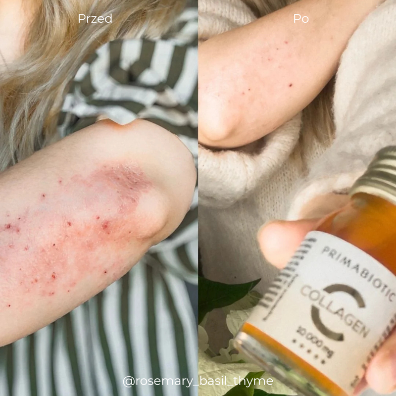 Efekty przed i po suplementacji kolagenu do picia Primabiotic Collagen. Na zdjęciu "po" widać brak strupów i blizn na skórze ręki